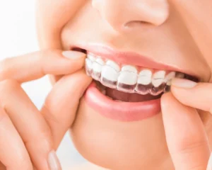 Custom Teeth Whitening Trays